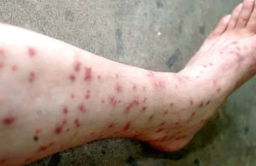 fleas on humans fleas on humans